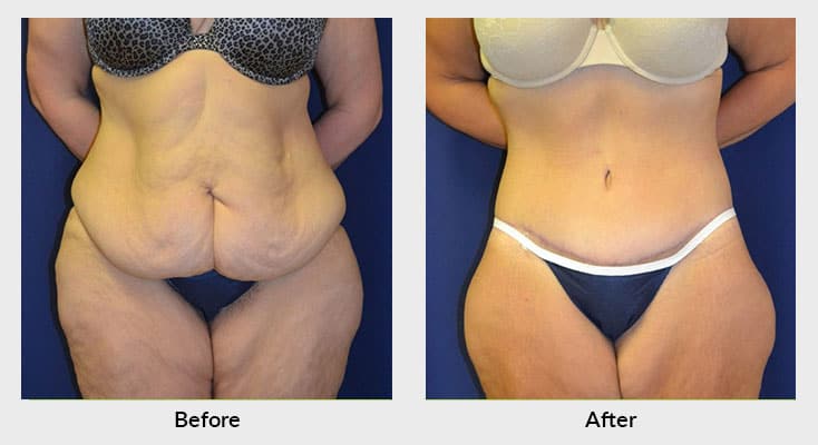 Body Contouring: Effects, Weight Loss, and Goal of Surgery