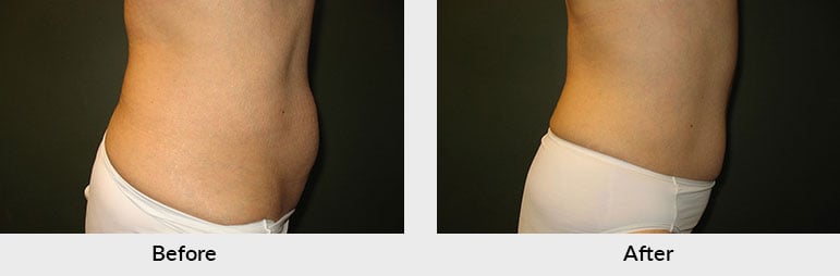 Is Coolsculpting Permanent? All About This Non-Invasive Procedure