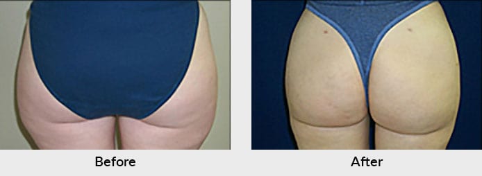 Liposuction and Vaser Liposuction Charlotte NC - Ultrasound