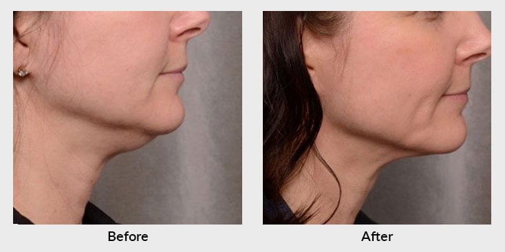 Skin Tightening Before & After - Charlotte Huntersville, NC: Saluja  Cosmetic and Laser Center