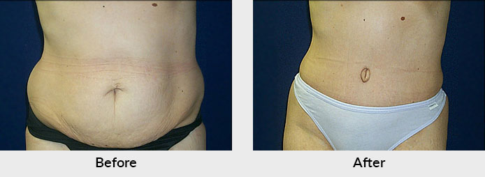 What is a Mini Tummy Tuck and How Does it Work?