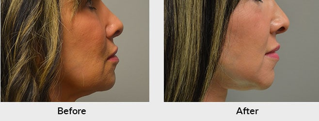Natural Looking Face and Neck Lift Results A natural looking face and neck  lift result is one where there are no obvious or telling signs that any  'work' has been done.